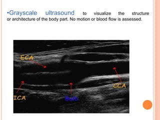 •Grayscale ultrasound to visualize the structure
or architecture of the body part. No motion or blood flow is assessed.
 