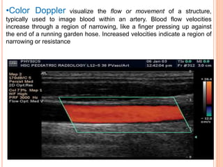 •Color Doppler visualize the flow or movement of a structure,
typically used to image blood within an artery. Blood flow velocities
increase through a region of narrowing, like a finger pressing up against
the end of a running garden hose. Increased velocities indicate a region of
narrowing or resistance
 