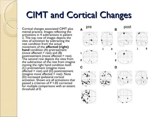 CIMT and Cortical Changes Cortical changes associated CIMT plus mental practice. Images reflecting the activations in 4 subtractions in patient 2. The top row of images depicts the sites of activation by subtracting the rest condition from the actual movement of the  affected (right) hand  condition (A) pretreatment (move affected > rest) and (B) posttreatment (move affected > rest). The second row depicts the sites from the subtraction of the rest from imagine moving the right hand condition both (C) pretreatment (imagine move affected > rest) and (D) posttreatment (imagine move affected > rest). Note (D) increased ipsilateral cortical activation. Shown are all activations that passed a criterion of  P  <.05 corrected for multiple comparisons with an extent threshold of 0. pre post 