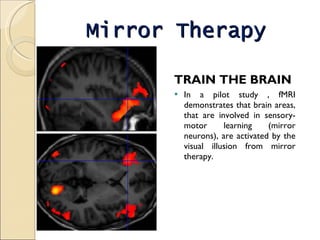 Mirror Therapy   TRAIN THE BRAIN In a pilot study , fMRI demonstrates that brain areas, that are involved in sensory-motor learning (mirror neurons), are activated by the visual illusion from mirror therapy. 