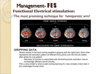 Management-  F E S Functional Electrical stimulation: The most promising technique for  hemiparetic arm! GRIPPING DATA:  Shows activity in the brain during repetitive gripping with the right hand. Each brain represents the activation pattern at different time points over the first six weeks after stroke for one patient. Recovery of function is associated with diminishing brain activation, due to increasingly efficient neural circuitry.  This is very similar to what is seen during learning of a new complex motor task in the undamaged human brain 