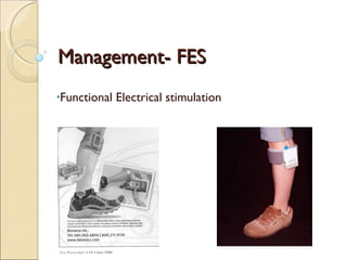 Management- FES Functional Electrical stimulation 