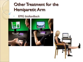 Other Treatment for the Hemiparetic Arm EMG biofeedback 
