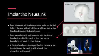 Implanting Neuralink
 Neuralink was originally supposed to be implanted
behind the ear with wired that would run inside the
head and connect to brain tissue.
 Now Neuralink will be implanted into the top of
head with a chip like device that has neural
threads to connect to brain tissue.
 A device has been developed by the company for
installation of the device which Musk has
presented to the public
 