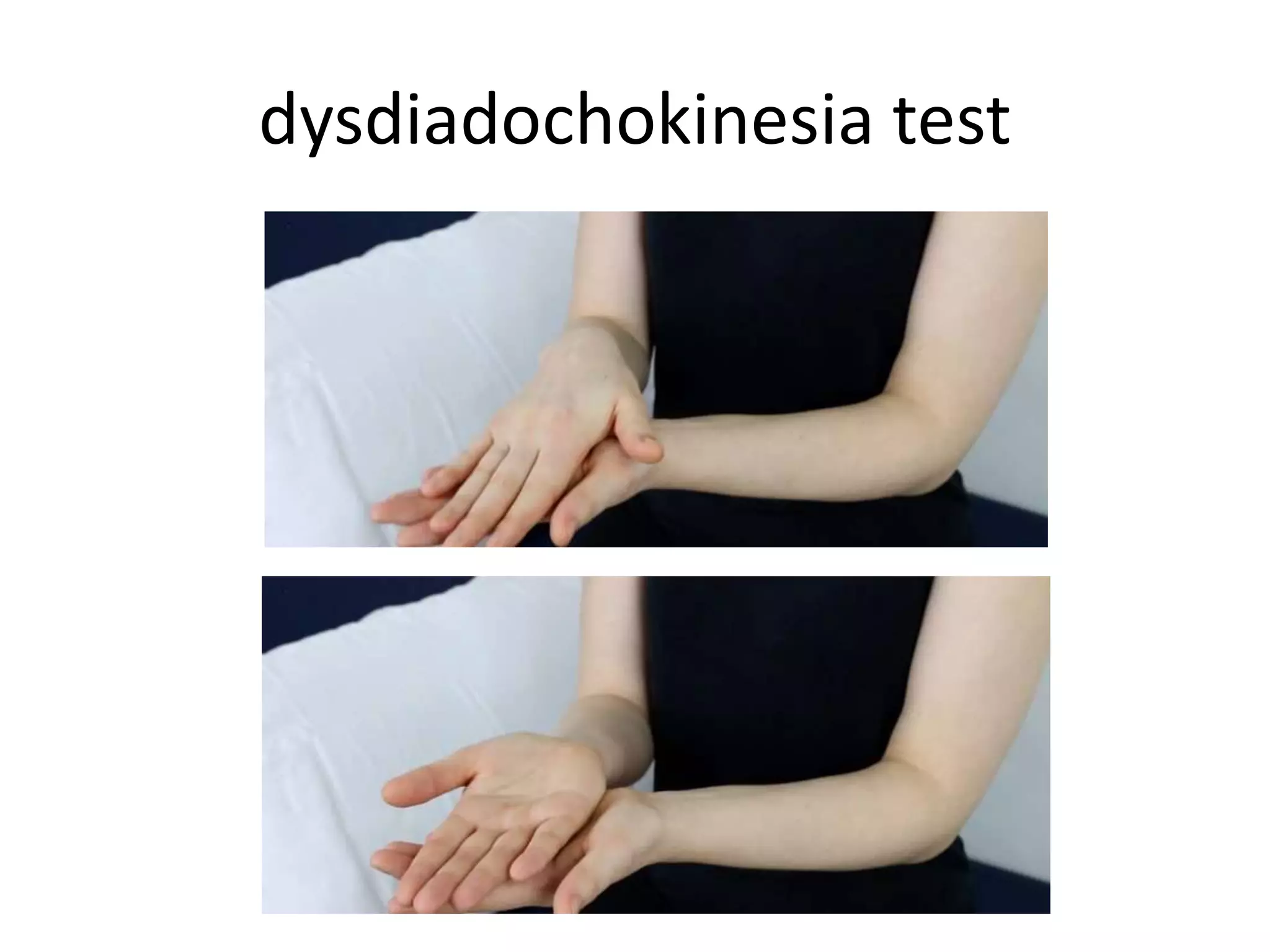 dysdiadochokinesia test