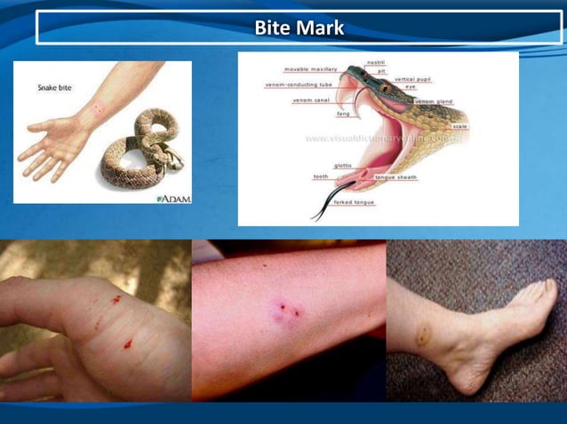 Management of neurotoxic snake bite