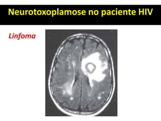 Neurotoxoplamose no paciente HIV
Linfoma
 