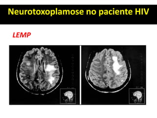 Neurotoxoplamose no paciente HIV
LEMP
 