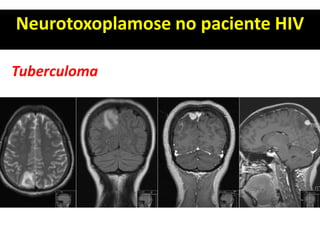 Neurotoxoplamose no paciente HIV
Tuberculoma
 