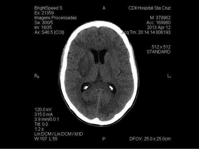 Neurotoxoplasmose