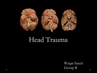 Head Trauma
Waqar Saeed
Group B
 