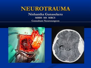 NEUROTRAUMA
 Nishantha Gunasekera
    MBBS MS MRCS
  Consultant Neurosurgeon
 