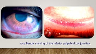 rose Bengal staining of the inferior palpebral conjunctiva.
 