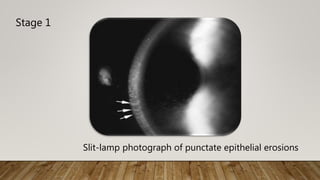 Slit-lamp photograph of punctate epithelial erosions
Stage 1
 
