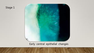 Stage 1
Early central epithelial changes
 
