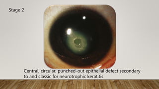 Central, circular, punched-out epithelial defect secondary
to and classic for neurotrophic keratitis
Stage 2
 