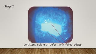Stage 2
persistent epithelial defect with rolled edges
 