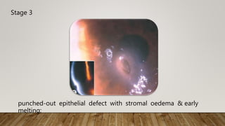 Stage 3
punched-out epithelial defect with stromal oedema & early
melting;
 