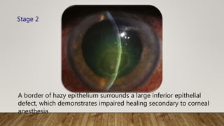 A border of hazy epithelium surrounds a large inferior epithelial
defect, which demonstrates impaired healing secondary to corneal
anesthesia
Stage 2
 