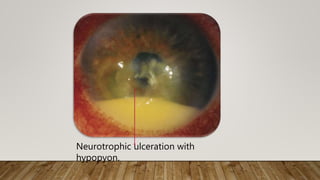Neurotrophic ulceration with
hypopyon.
 