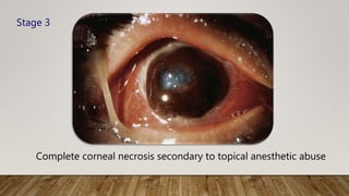 Complete corneal necrosis secondary to topical anesthetic abuse
Stage 3
 