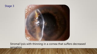 Stromal lysis with thinning in a cornea that suffers decreased
sensation
Stage 3
 
