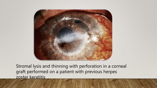 Stromal lysis and thinning with perforation in a corneal
graft performed on a patient with previous herpes
zoster keratitis
 