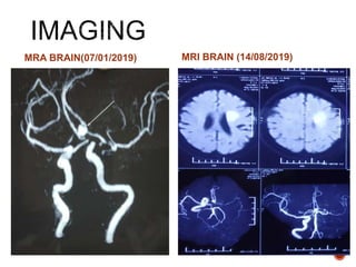 MRA BRAIN(07/01/2019) MRI BRAIN (14/08/2019)
 