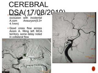  Complete Left ICA
occlusion with incidental
A.com Aneurysm(5.3×
4.1mm)
 Good cross flow across
Acom A. filling left MCA
territory, some delay noted
in collateral flow
 