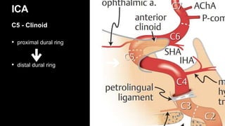• proximal dural ring
• distal dural ring
ICA
C5 - Clinoid
 