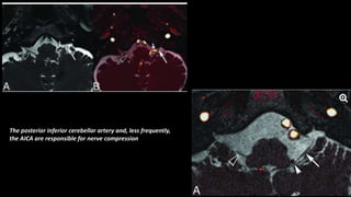 Neurovascular compression syndromes.pptx