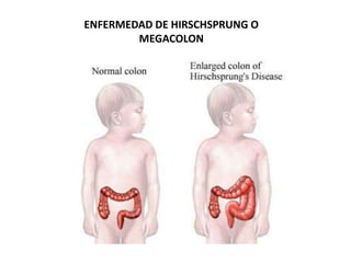 ENFERMEDAD DE HIRSCHSPRUNG O
        MEGACOLON
 