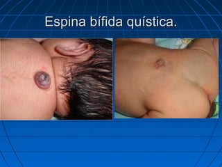 Espina bífida quística.Espina bífida quística.
 