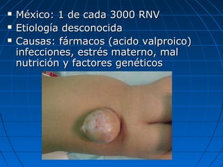  México: 1 de cada 3000 RNVMéxico: 1 de cada 3000 RNV
 Etiología desconocidaEtiología desconocida
 Causas: fármacos (acido valproico)Causas: fármacos (acido valproico)
infecciones, estrésinfecciones, estrés materno, malmaterno, mal
nutrición y factores genéticosnutrición y factores genéticos
 