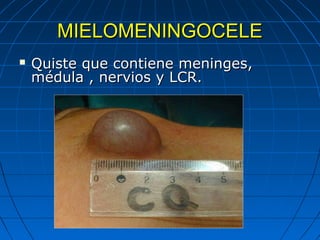 MIELOMENINGOCELEMIELOMENINGOCELE
 Quiste que contiene meninges,Quiste que contiene meninges,
médula , nervios y LCR.médula , nervios y LCR.
 