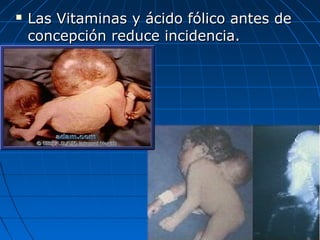  Las Vitaminas y ácido fólico antes deLas Vitaminas y ácido fólico antes de
concepción reduce incidencia.concepción reduce incidencia.
 