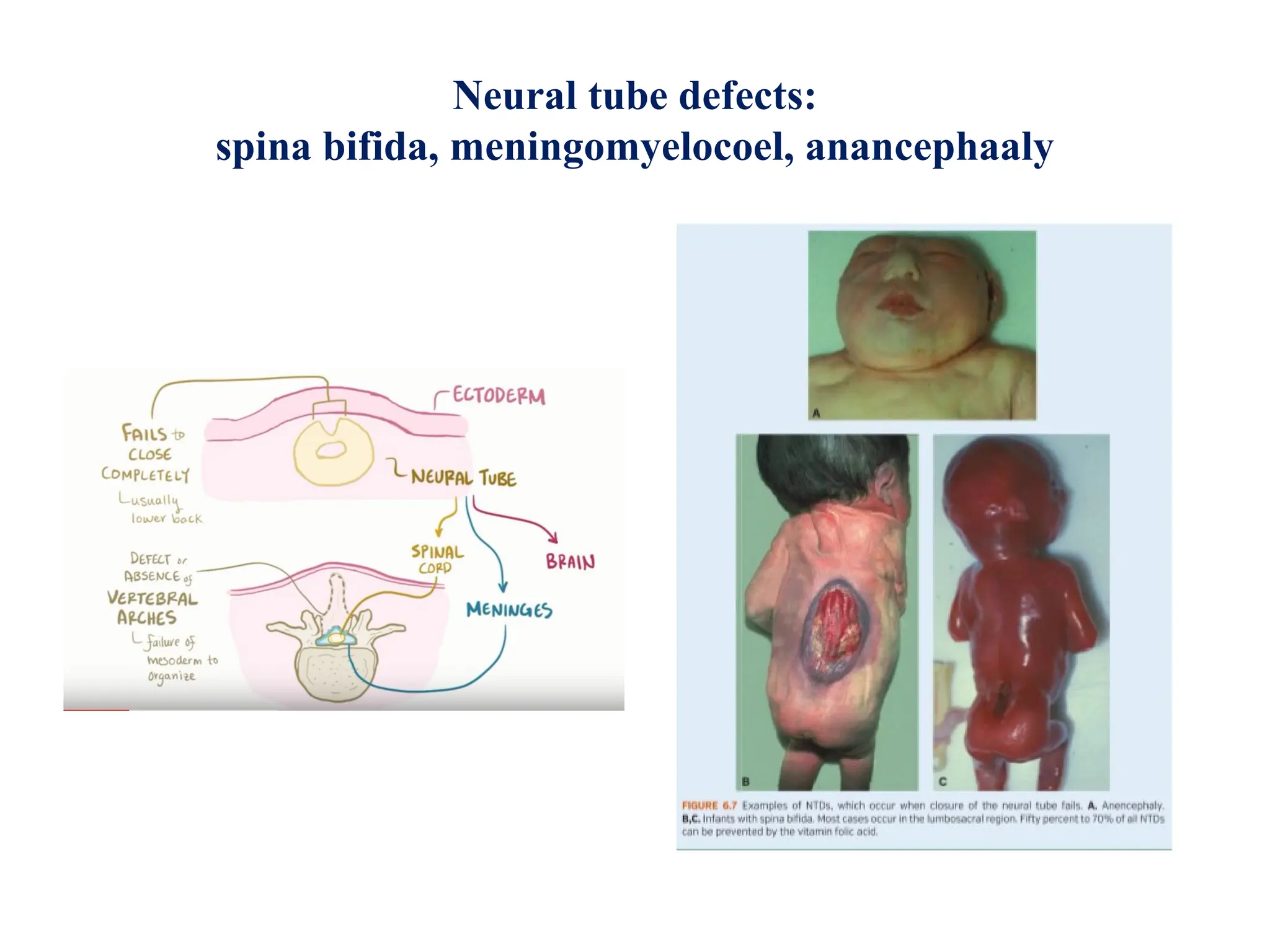 Neural tube defects:
spina bifida, meningomyelocoel, anancephaaly
 