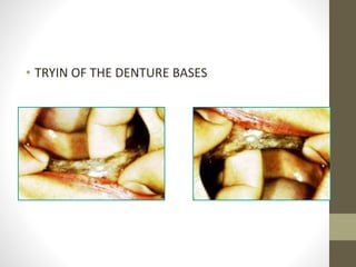 • TRYIN OF THE DENTURE BASES
 