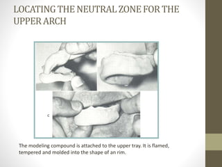 LOCATINGTHE NEUTRALZONEFOR THE
UPPERARCH
The modeling compound is attached to the upper tray. It is flamed,
tempered and molded into the shape of an rim.
 
