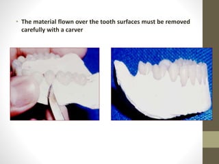 • The material flown over the tooth surfaces must be removed
carefully with a carver
 