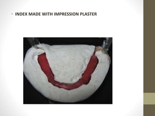 • INDEX MADE WITH IMPRESSION PLASTER
 