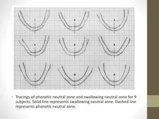 • Tracings of phonetic neutral zone and swallowing neutral zone for 9
subjects. Solid line represents swallowing neutral zone. Dashed line
represents phonetic neutral zone.
 
