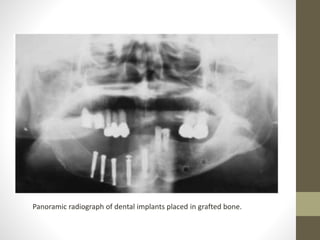 Panoramic radiograph of dental implants placed in grafted bone.
 