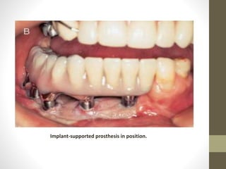 •
Implant-supported prosthesis in position.
 