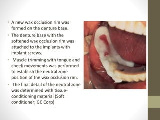 • A new wax occlusion rim was
formed on the denture base.
• The denture base with the
softened wax occlusion rim was
attached to the implants with
implant screws.
• Muscle trimming with tongue and
cheek movements was performed
to establish the neutral zone
position of the wax occlusion rim.
• The final detail of the neutral zone
was determined with tissue-
conditioning material (Soft
conditioner; GC Corp)
 