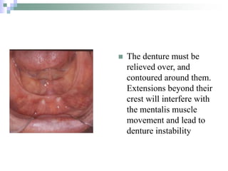  The denture must be
relieved over, and
contoured around them.
Extensions beyond their
crest will interfere with
the mentalis muscle
movement and lead to
denture instability
 