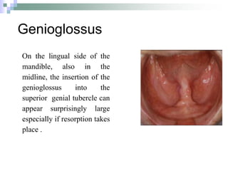 Genioglossus
On the lingual side of the
mandible, also in the
midline, the insertion of the
genioglossus into the
superior genial tubercle can
appear surprisingly large
especially if resorption takes
place .
 