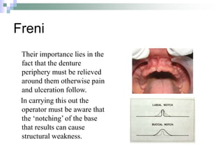 Freni
Their importance lies in the
fact that the denture
periphery must be relieved
around them otherwise pain
and ulceration follow.
In carrying this out the
operator must be aware that
the ‘notching’ of the base
that results can cause
structural weakness.
 