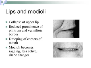 Lips and modioli
 Collapse of upper lip
 Reduced prominence of
philtrum and vermilion
border
 Drooping of corners of
mouth
 Modioli becomes
sagging, less active,
shape changes
 