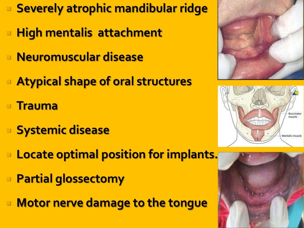 Neutral zone impression technique